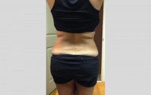 Before Strawberry Laser Lipo