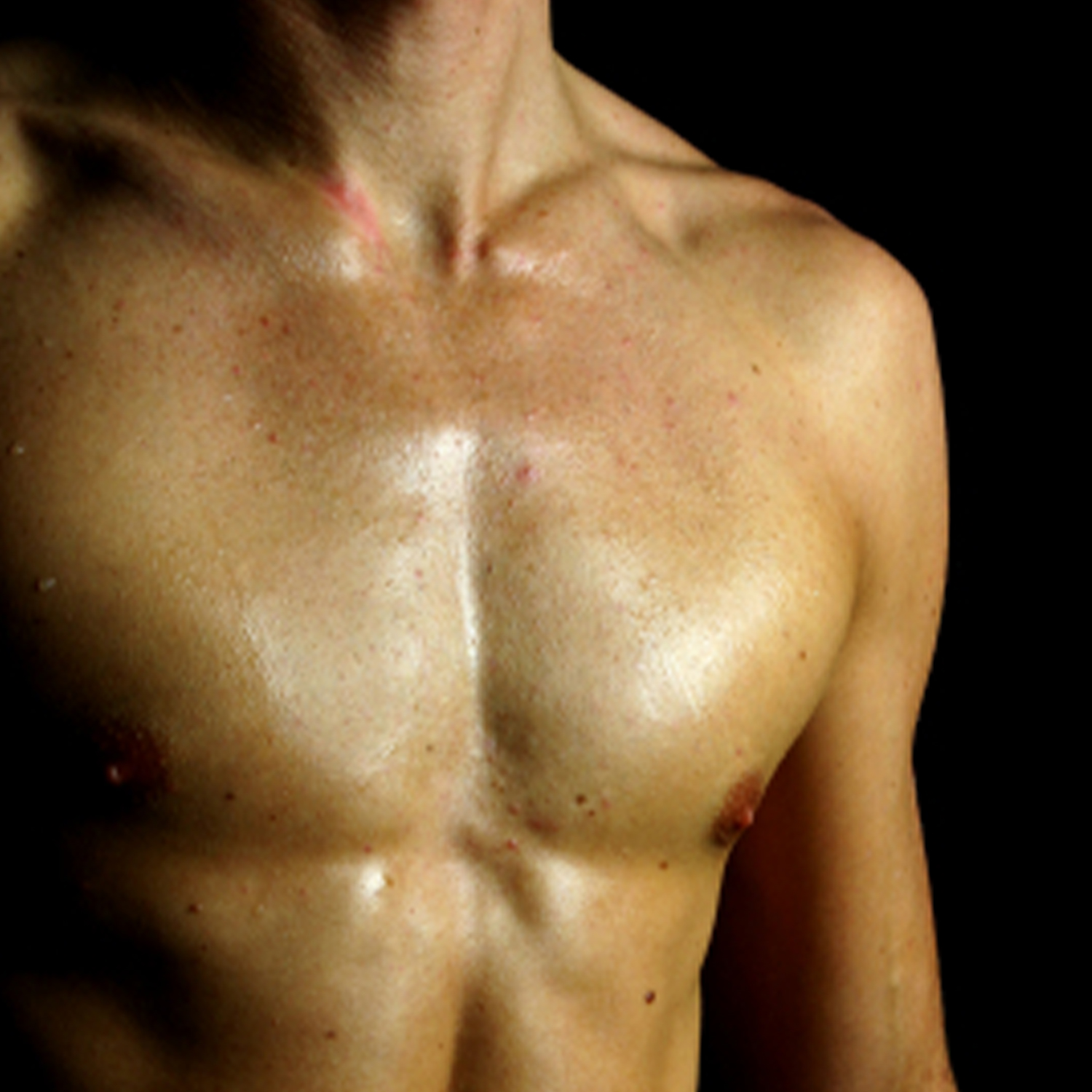 Male Breast Reduction (Gynecomastia)