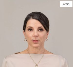 Before Before