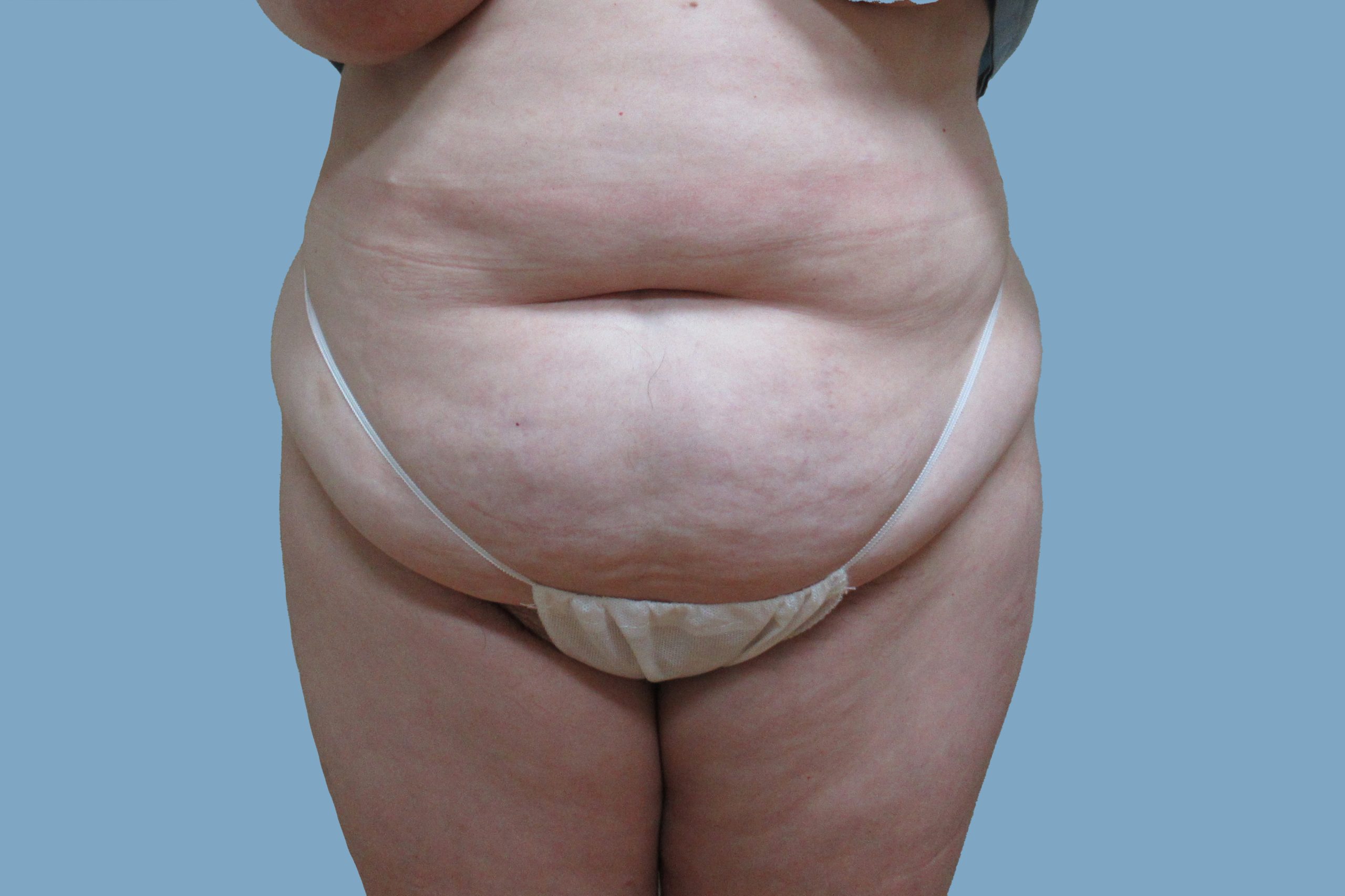 Reverse Abdominoplasty: Is It Right for You? - The Lucas Center